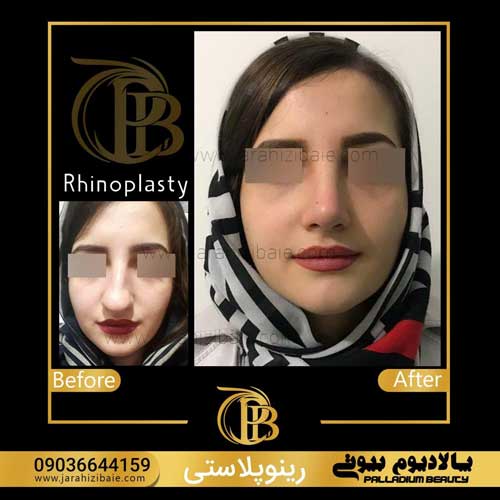 جراحی بینی را برای چه باید انجام بدیم و باید چه نکاتی رو لحاظ کنیم ؟