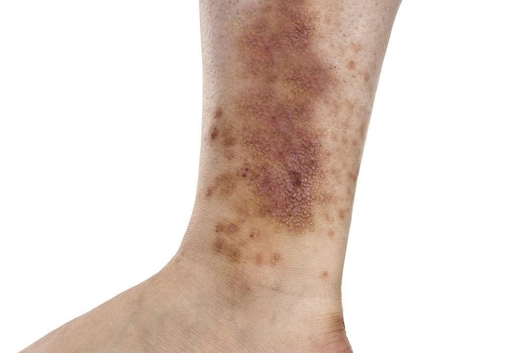 علت لکه های قهوه ای روی پا چیست