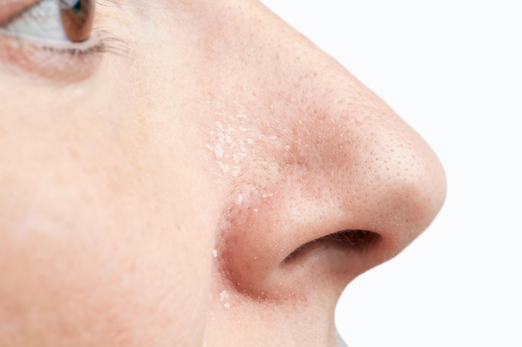 خشکی پوست در اطراف بینی