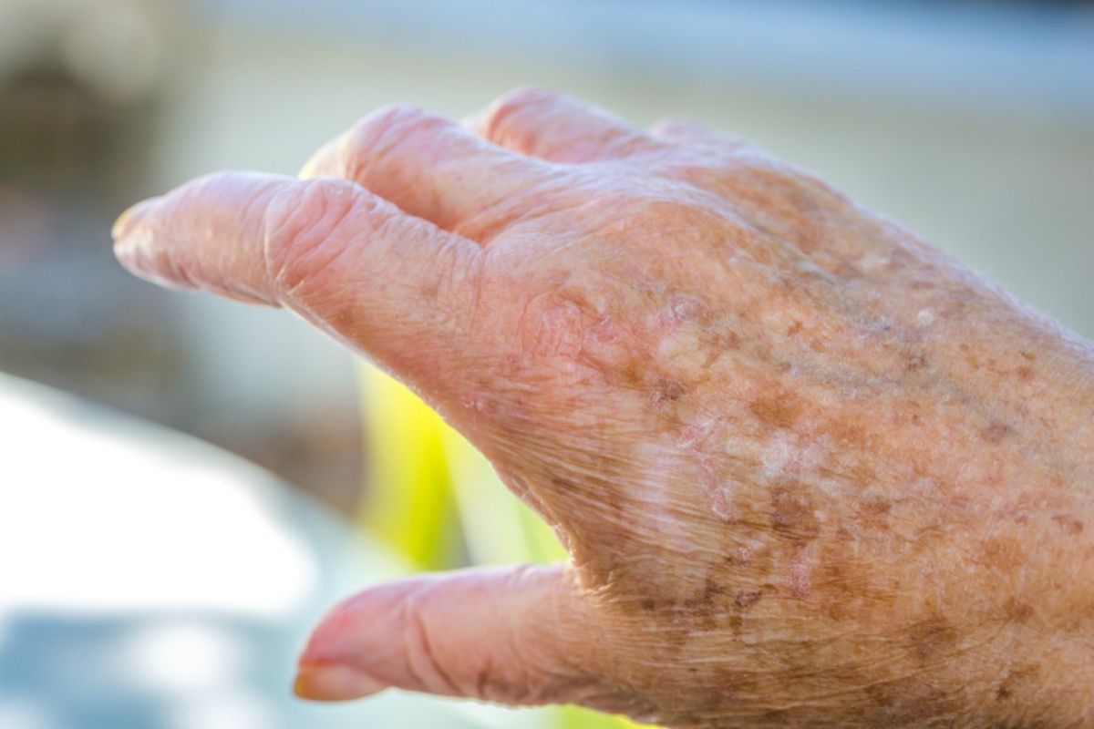 علت خشکی پوست در سالمندان