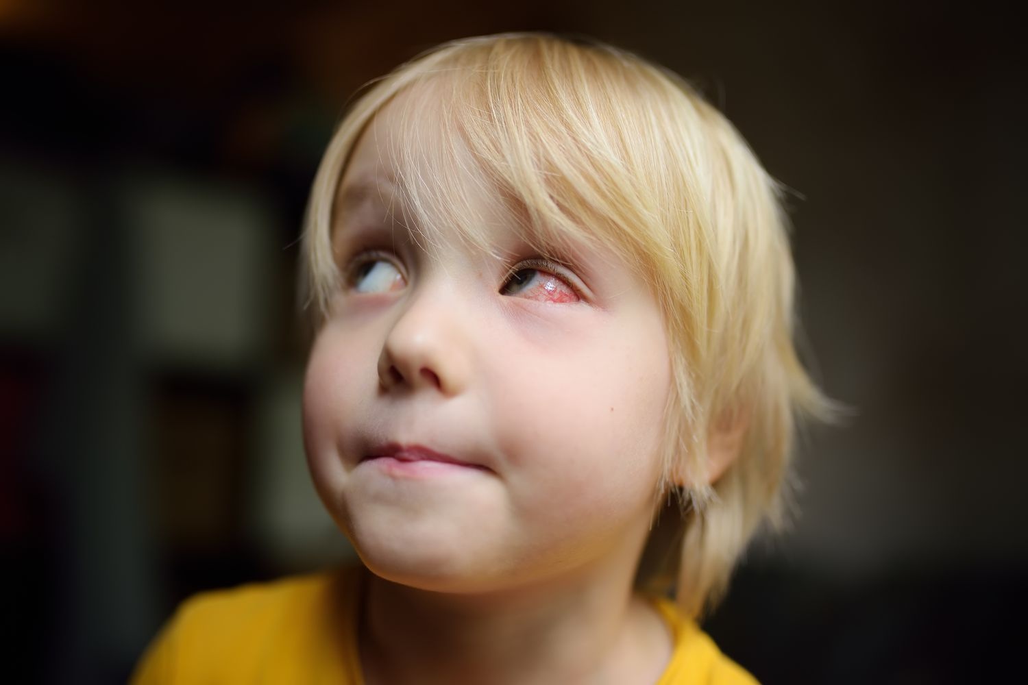علائم سلولیت چشم در کودکان 