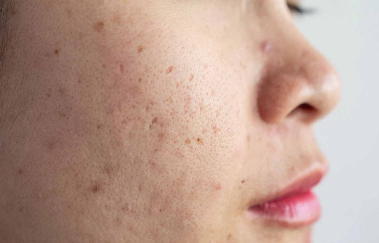  محلول کلیندامایسین موثر در درمان جوش صورت