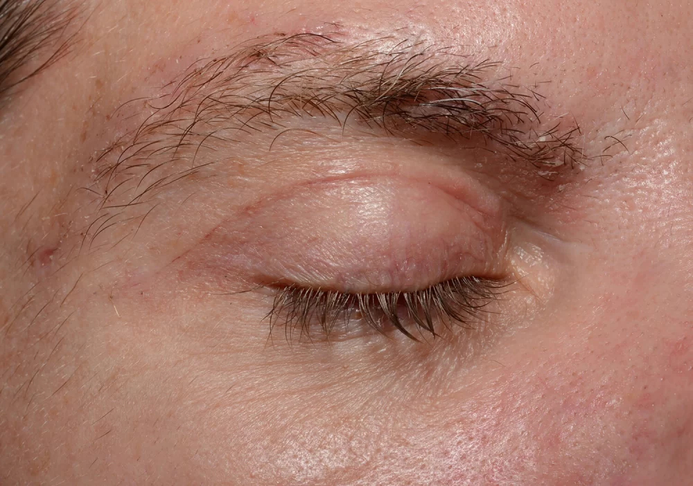 جراحی زیبایی پلک