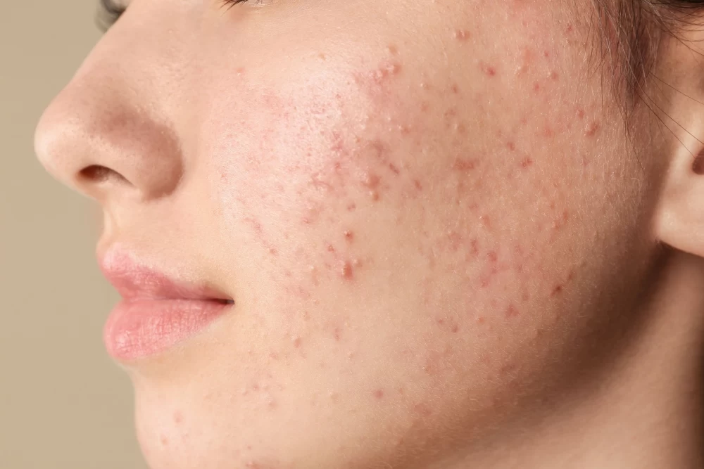 فواید و معایب تزریق ژل جای جوش