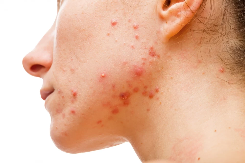 تزریق ژل جای جوش