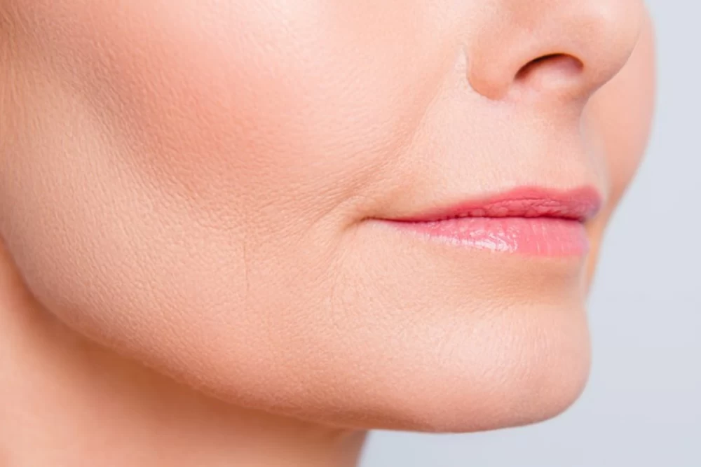  تزریق ژل خط لبخند