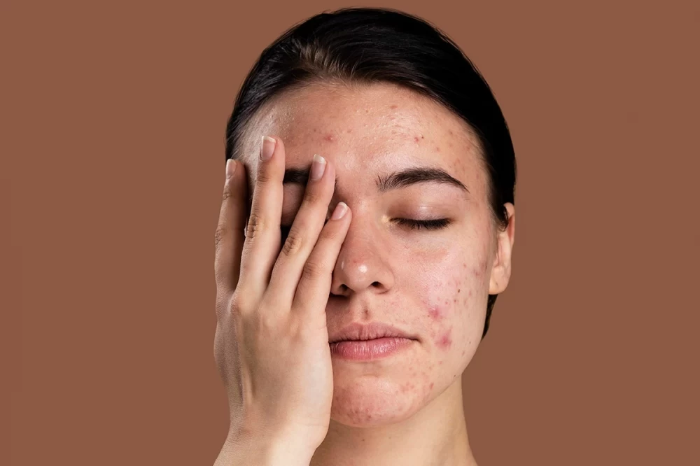 چرا ضد آفتاب میزنم جوش میزنم؟