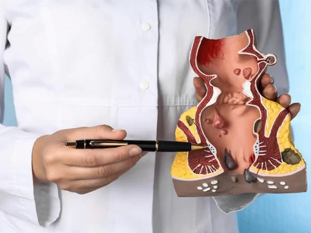 پیشگیری از بواسیر و کیست مویی