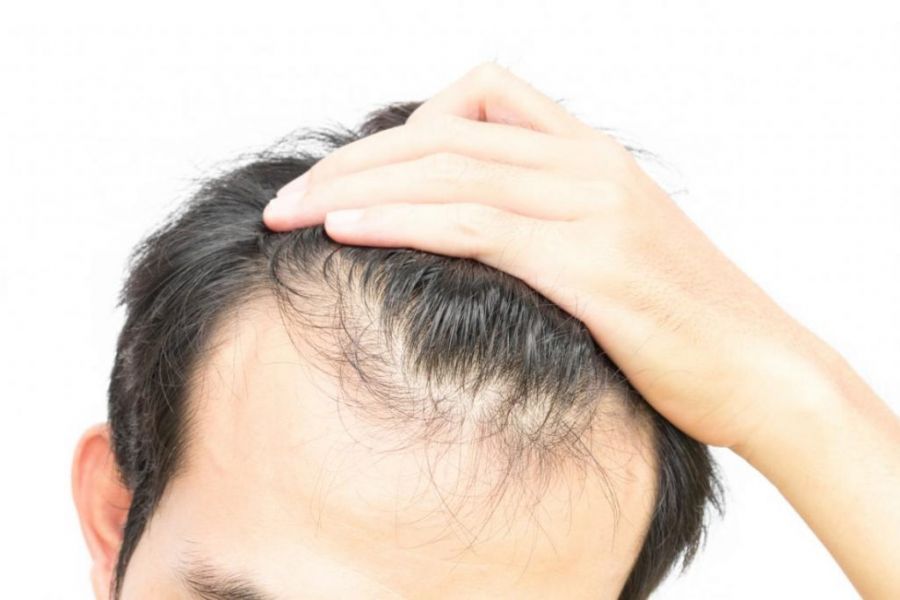 ریزش مو پس از عمل چیست؟ چرا اتفاق میافتد؟
