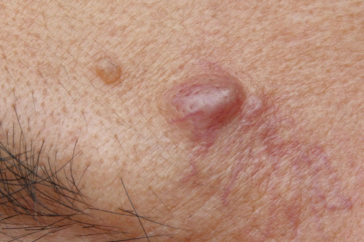 علت کیست پوستی صورت چیست؟