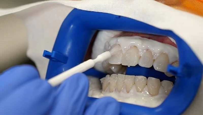 سفید کردن دندانها، سریع و ماندگار در دندانپزشکی های شهریار و اندیشه