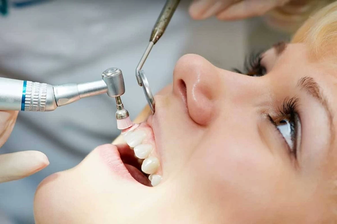 سفید کردن دندانها، سریع و ماندگار در دندانپزشکی های شهریار و اندیشه