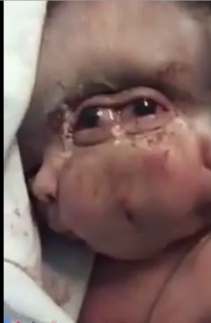 تولد نوزادی عجیب با ۳ سر و ۳ چشم