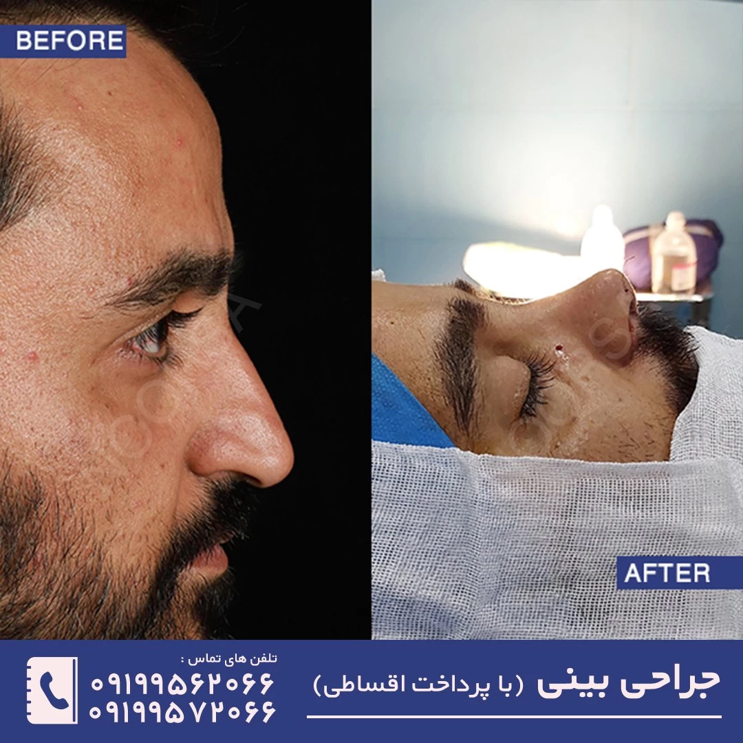 قبل و بعد از عمل بینی
