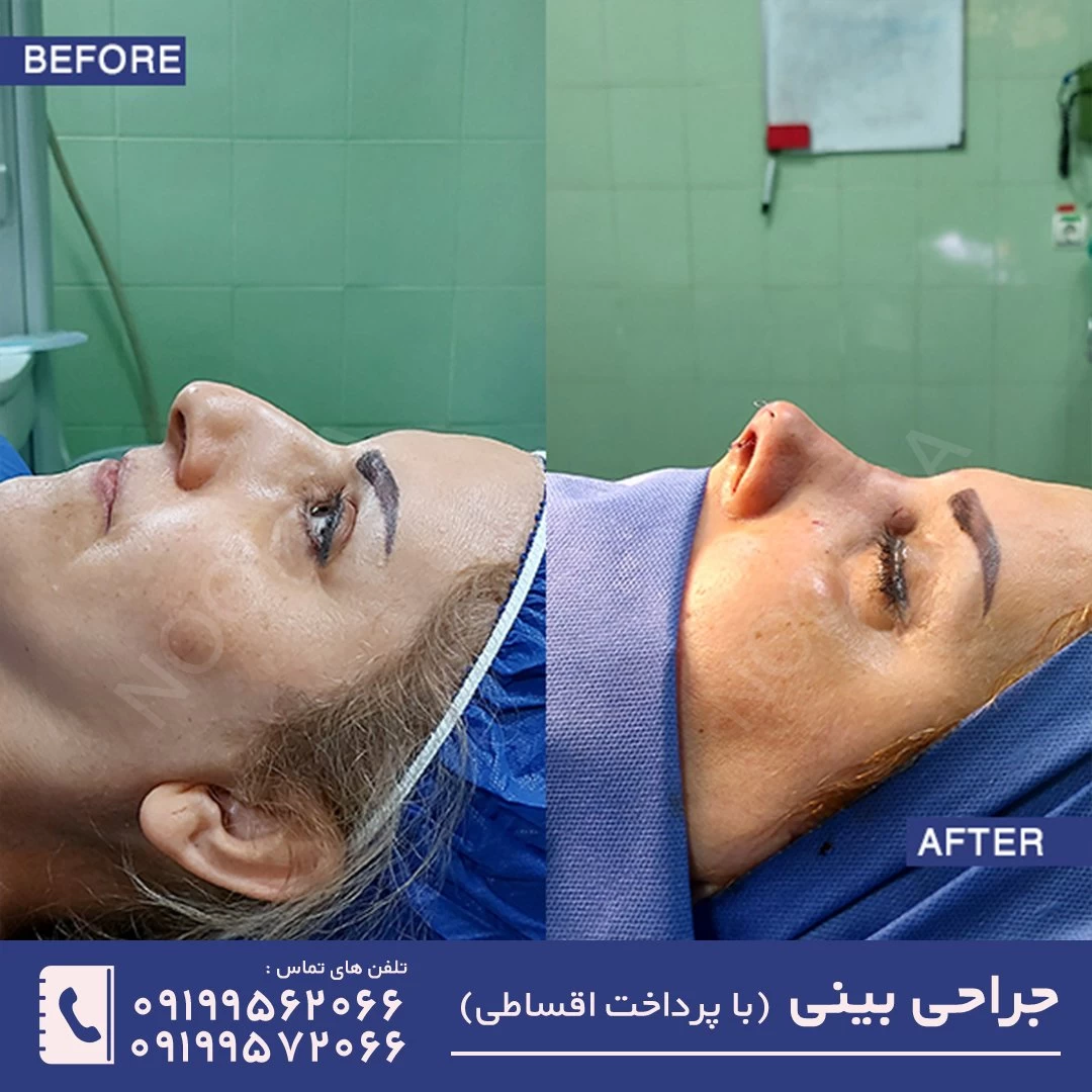 قبل و بعد از جراحی بینی