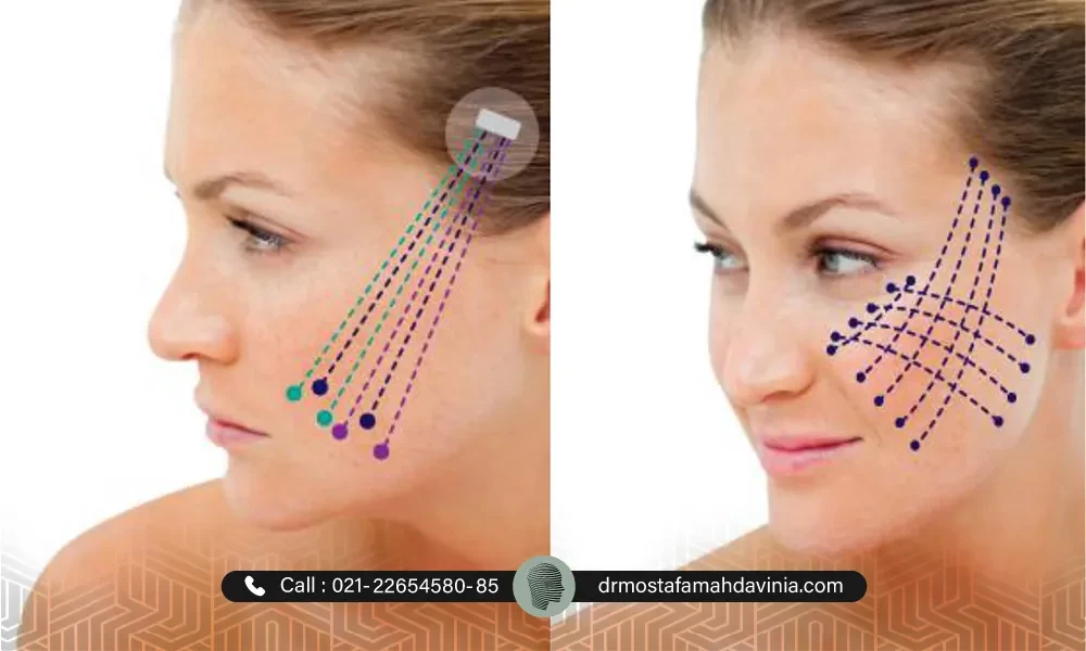 نواحی لیفتیک صورت با نخ PDO