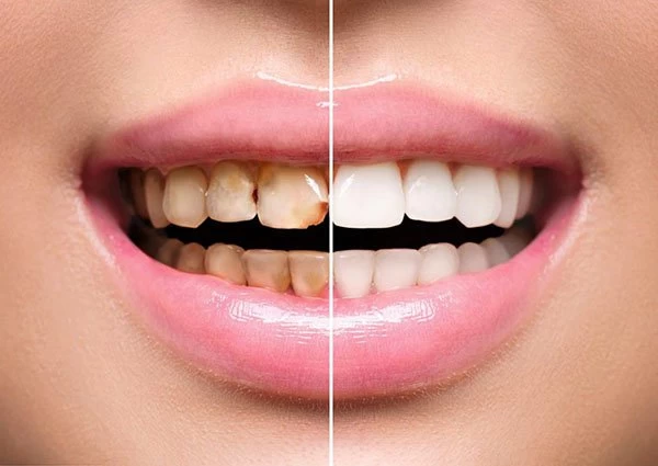 برای زیبایی دندان چه کار کنیم؟ لمینت دندان یا کامپوزیت دندان