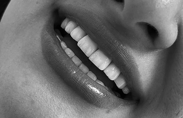 برای زیبایی دندان چه کار کنیم؟ لمینت دندان یا کامپوزیت دندان