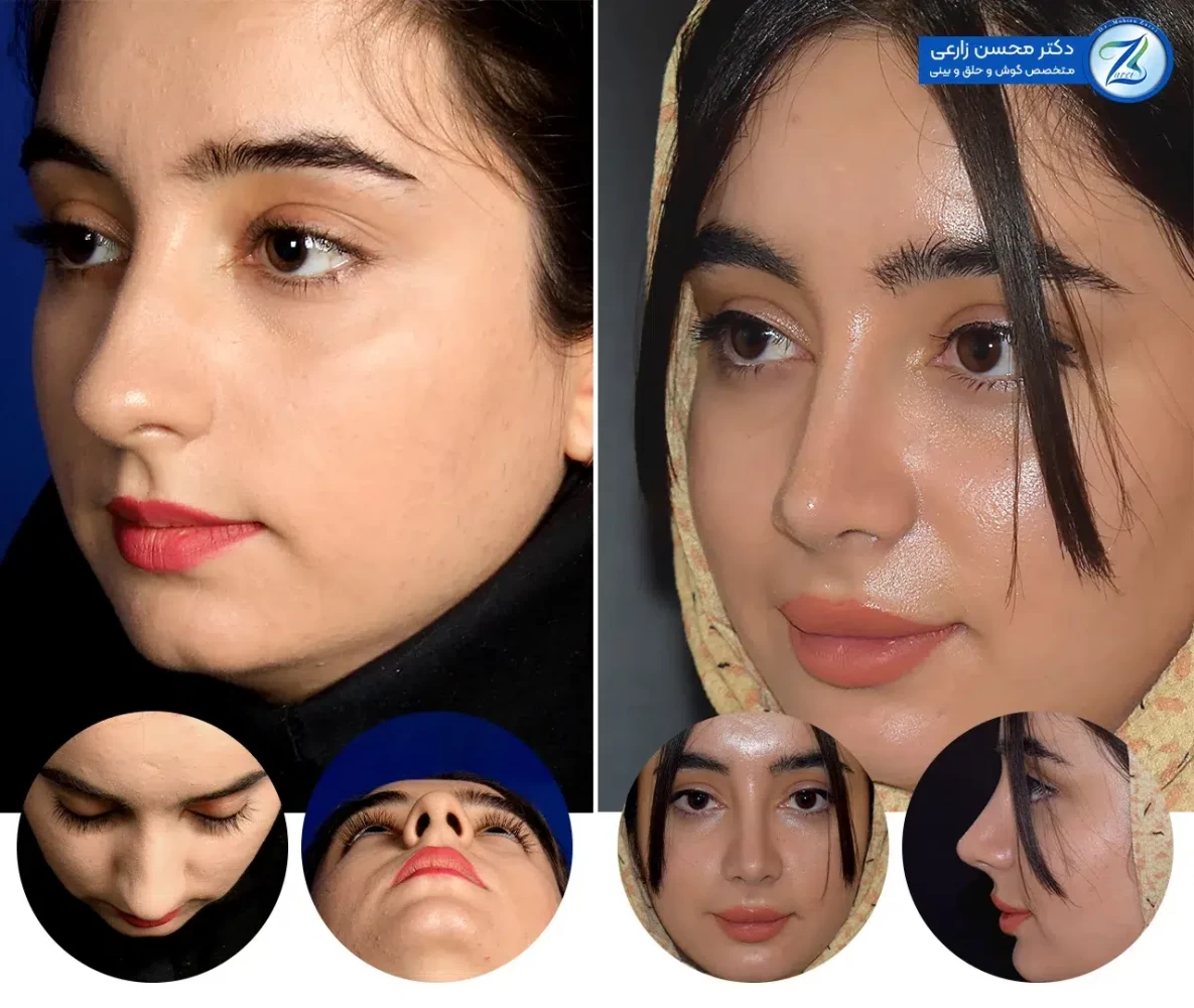 چه عواملی بر روی قیمت عمل بینی موثر هستند؟