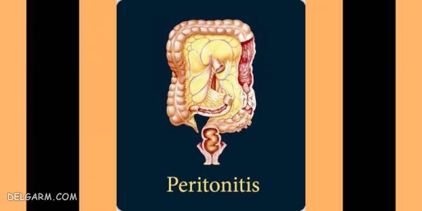 علائم و درمان بیماری پریتونیت
