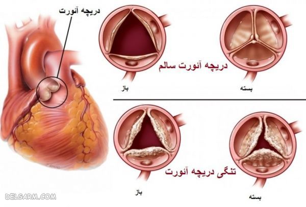 عوارض تنگی دریچه آئورت