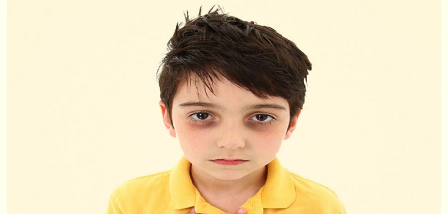 علت تیرگی دور چشم نوزادان چیست و چگونه درمان میشود ؟