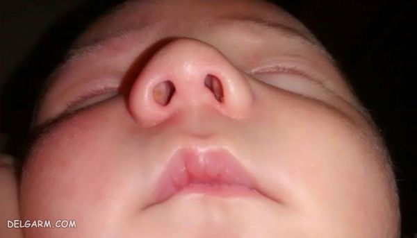 علت خرخر کودک در خواب / گرفتگی بینی و خروپف در کودکان / دارو برای خروپف کودکان / علت خروپف کودک شش ساله / علت خروپف در کودکان