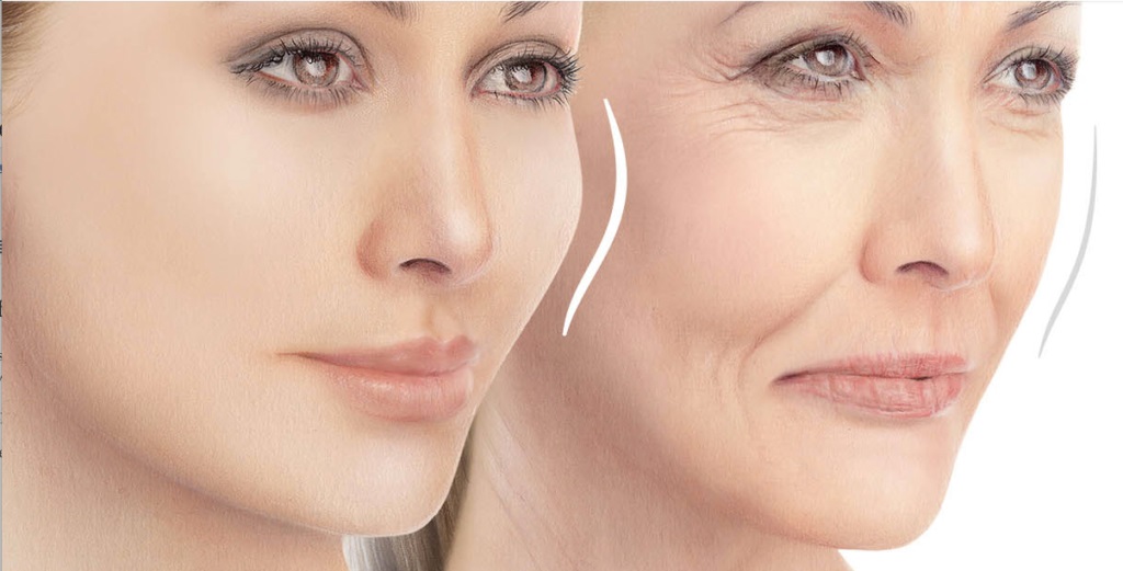 خط خنده را چگونه از بین ببریم ؟