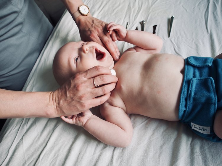 طب سوزنی در نوزادان چگونه انجام میشود ؟
