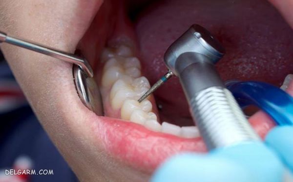 عصب کشی دندان واقعی | عصب کشی دندان درد دارد | مراحل عصب کشی دندان عفونی