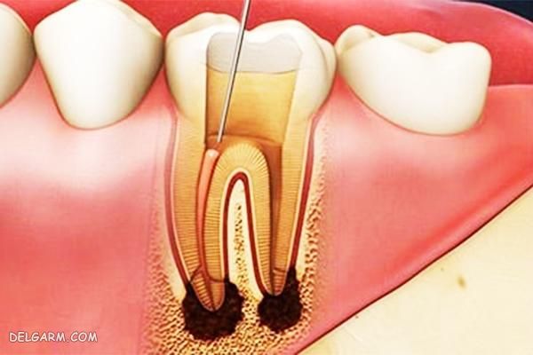 عوارض عصب کشی دندان | علائم به عصب رسیدن دندان | عمر دندان عصب کشی شده |تشخیص عصب کشی دندان از روی عکس |تشخیص به عصب رسیدن دندان