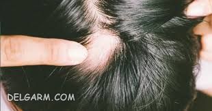 آلوپسی یا ریزش مو | زخم پوست سر