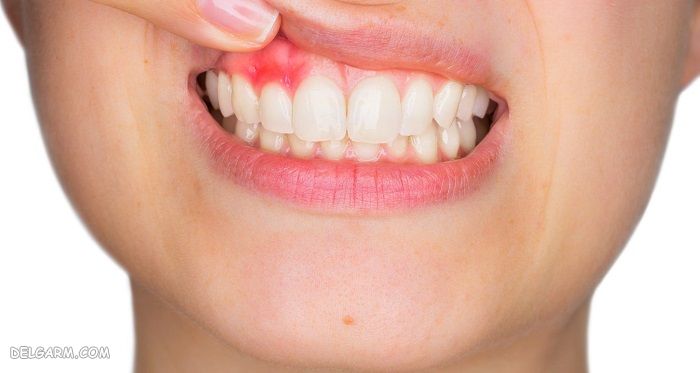 تجمع چرک آبسه