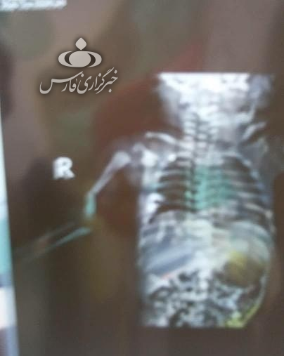 تولد نوزاد خرمشهری با دست شکسته