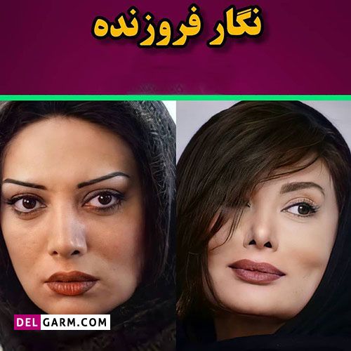 بازیگران زن ایرانی بعد از کاشت گونه