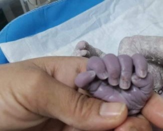 تولد نوزادی عجیب‌ الخلقه در عراق!