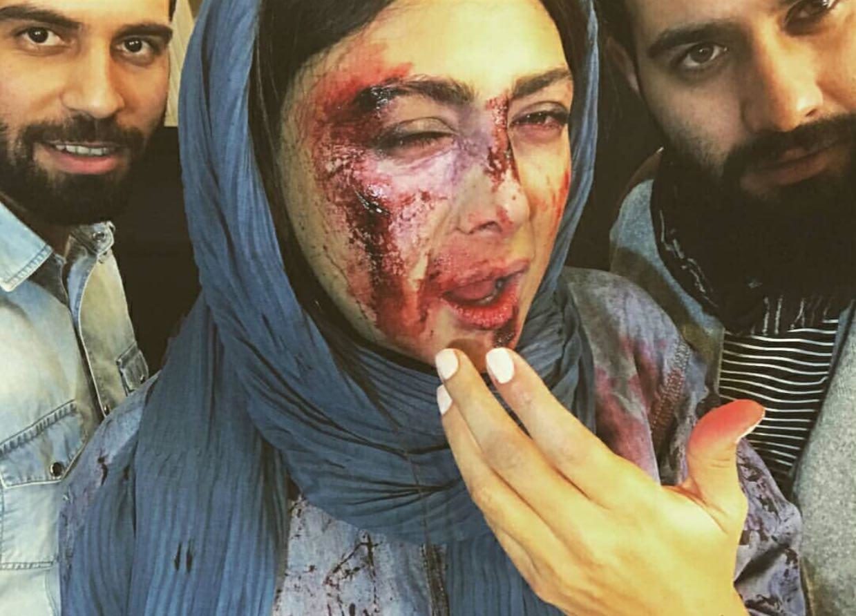 خانم بازیگر با صورت زخمی و کتک خورده !!