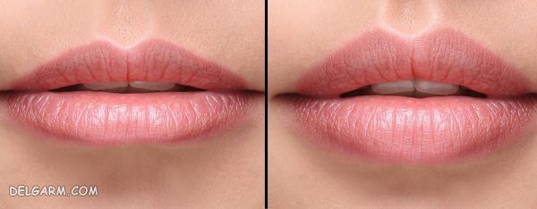 تزریق ژل لب/انواع تزریق ژل لب/تزریق ژل لب زیبایی/مراقبت بعد از تزریق ژل لب/هزینه تزریق ژل لب/فیلم تزریق ژل لب/تاثیر گرما بر ژل لب/ژل لب/ژل لب چیست