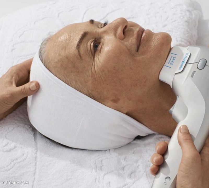 عوارض هایفوتراپی صورت