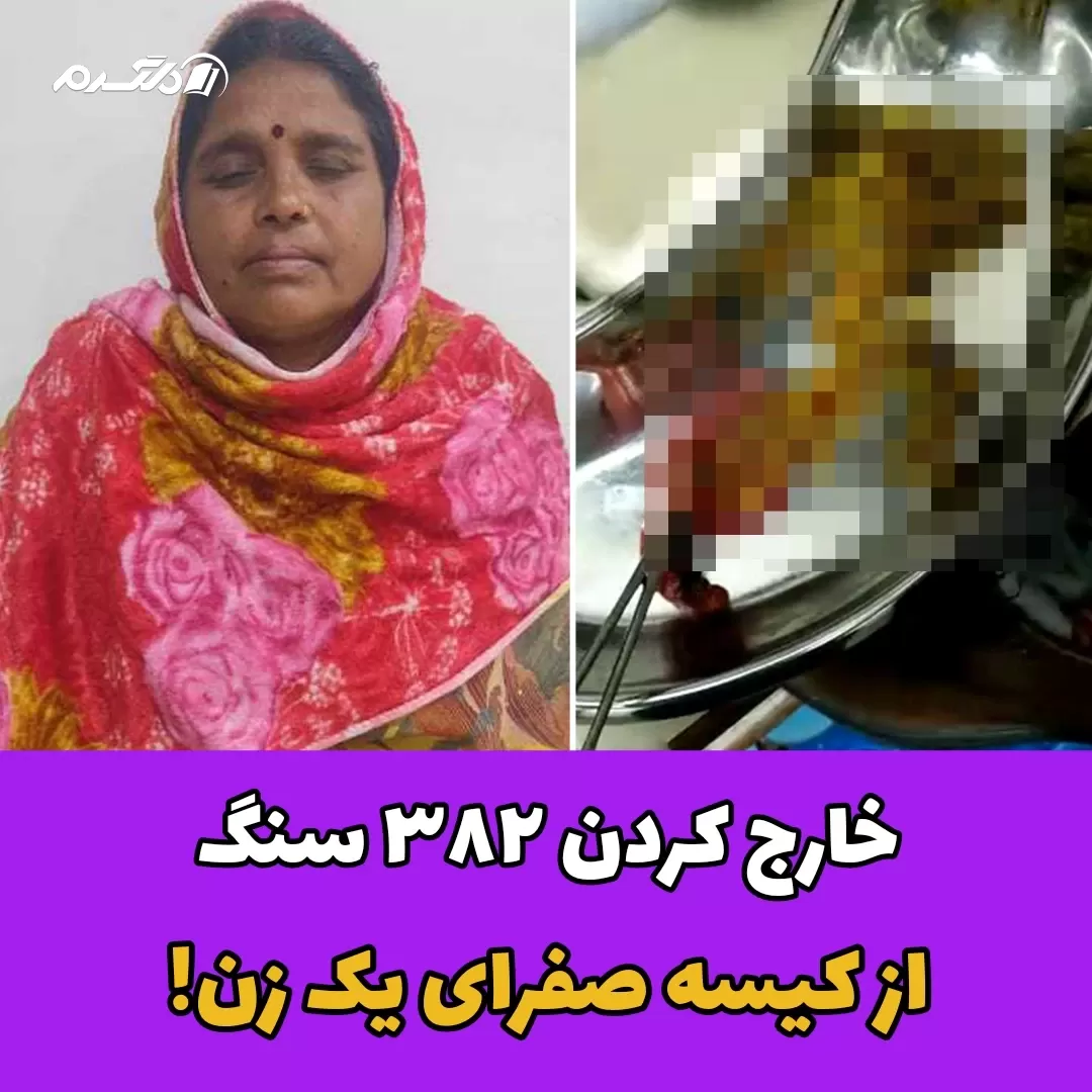 خارج کردن ۳۸۲ سنگ از کیسه صفرای یک زن