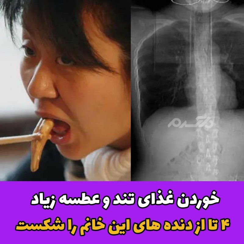 غذای چینی /شکستگی دنده