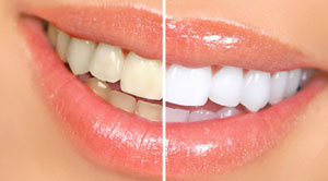 چگونه در خانه دندان های خود را سفید کنیم؟