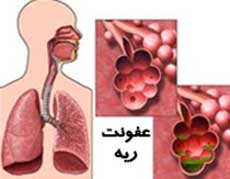 عفونت ریه و چند نمونه از بیماری‌های آن