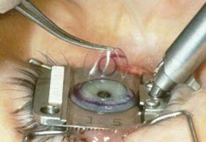 آیا عمل لیزیک چشم مفید است؟
