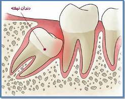 دندان نهفته دندان نهفته