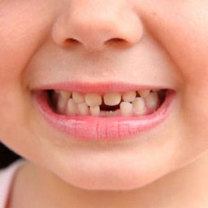 پوسیدگی دندان کودکان واگیردار است