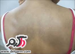 بیماری آميلوئيدوز