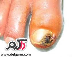 از بیماری برگر چه میدانید؟