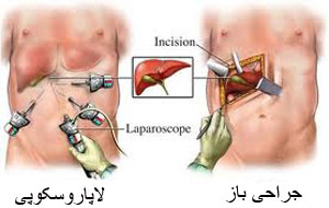 از لاپاروسکوپی یا جراحی باز چه میدانید ؟
