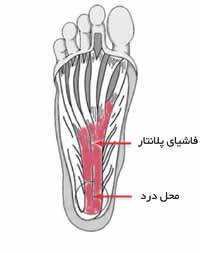 خار پاشنه چیست و علت درد پاشنه پا کجاست خار پاشنه چیست و علت درد پاشنه پا کجاست